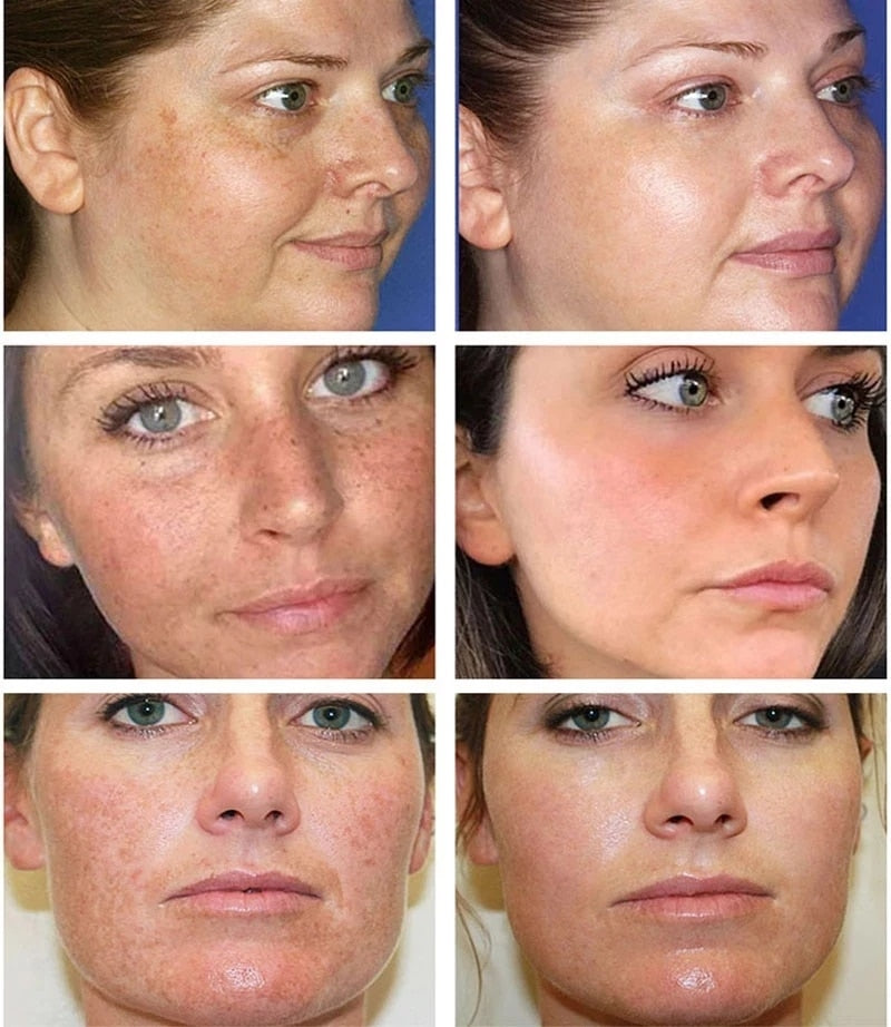 Remove Freckle Dark Spots Cream